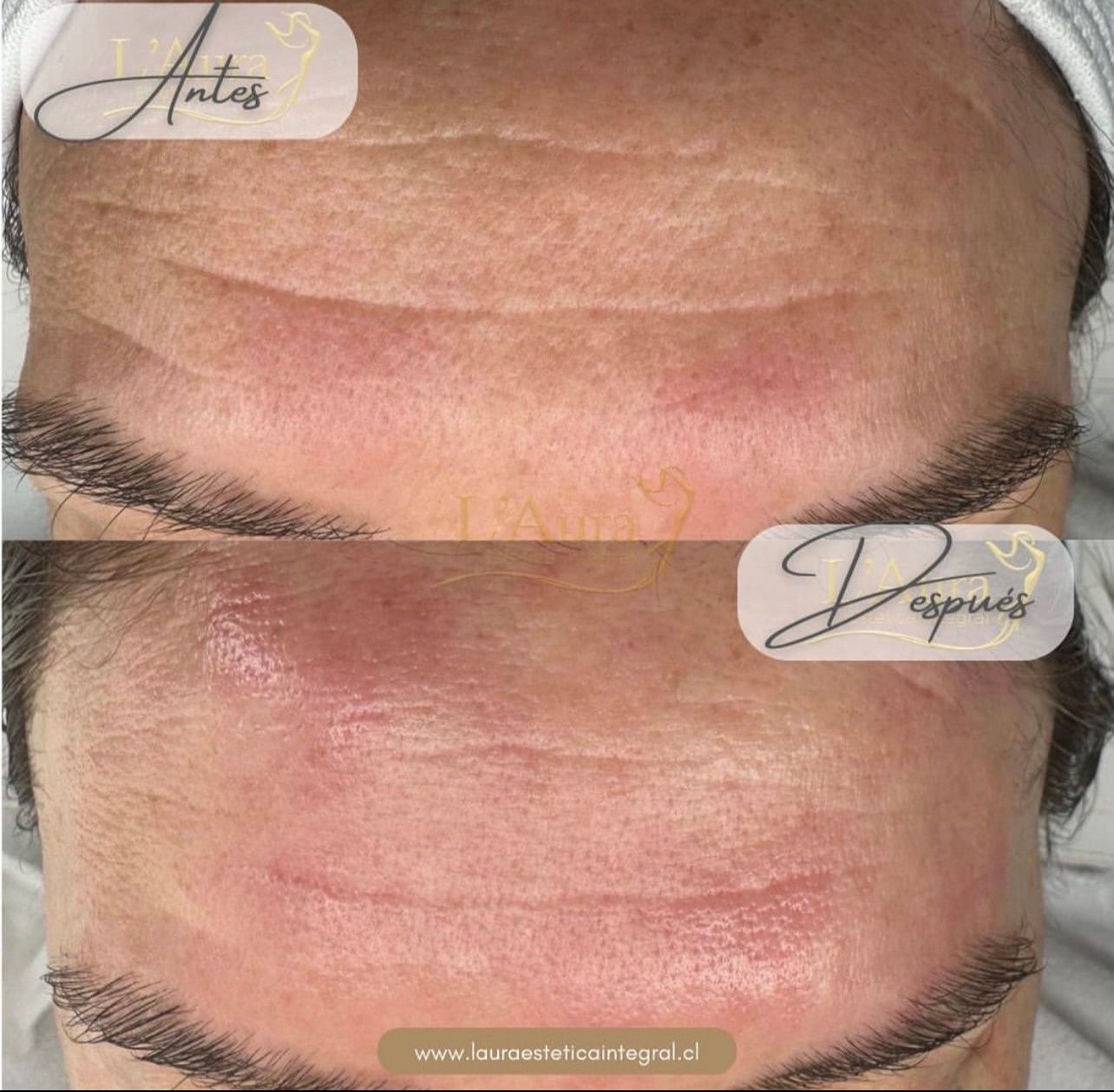 Limpieza facial profunda premium con Carboxiterapia CO2 - Imagen 4