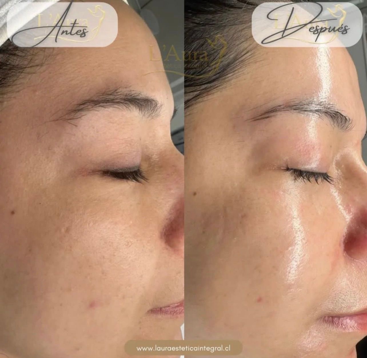 Limpieza facial profunda premium con Carboxiterapia CO2 - Imagen 5