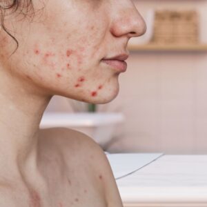 Peeling control acne