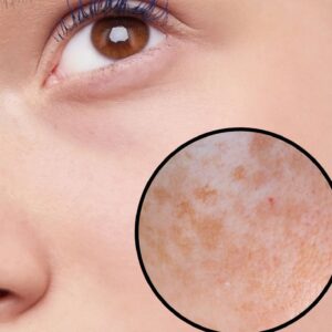 F-melaclear manchas y melasma