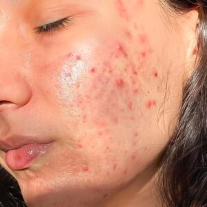 Tratamiento integral para el acne