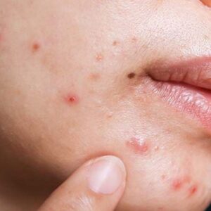 Acne detox