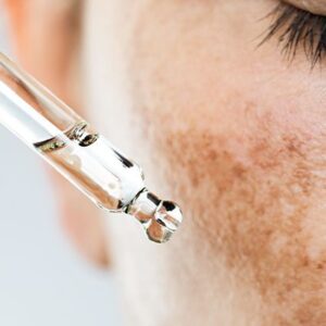 Peeling control melasma